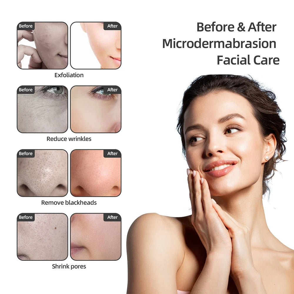 Foreverlily Professional Diamond Microdermabrasion Machine for Skin Care